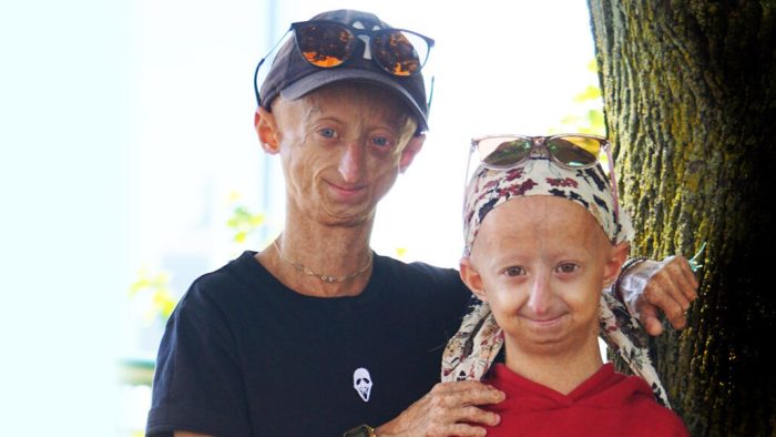 Progeria aging genetic medikal rapidly fda belgium approved genetik sciencenews