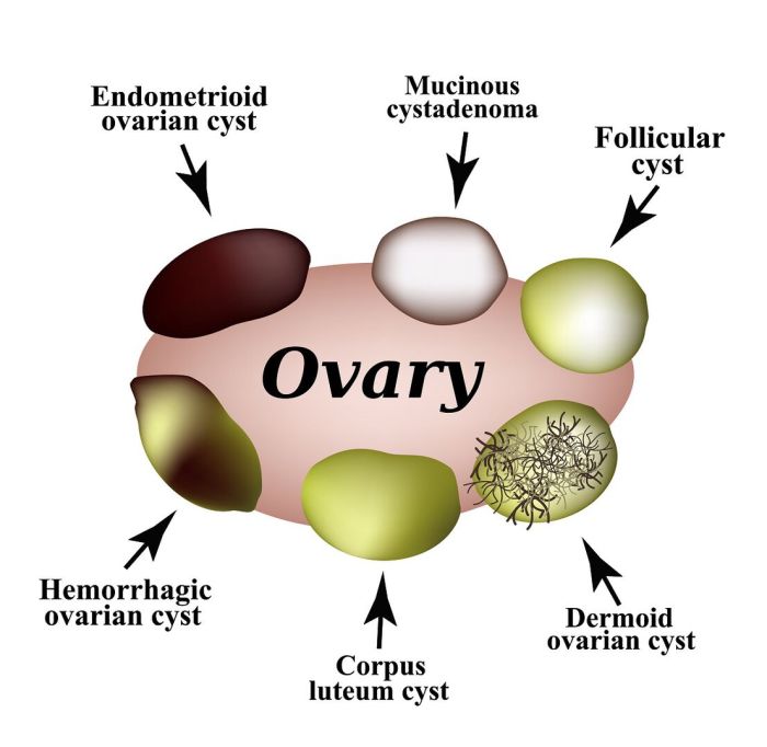 Penyebab Kista Ovarium