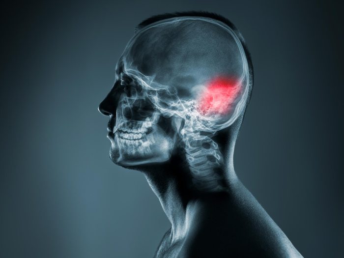 Golongan Darah Berisiko Terkena Stroke