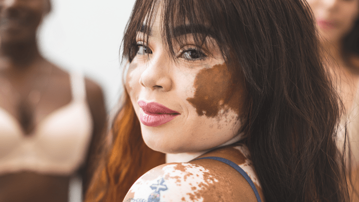 Vitiligo hair face facial pigment causes symptoms color patches diseases mayo clinic loss