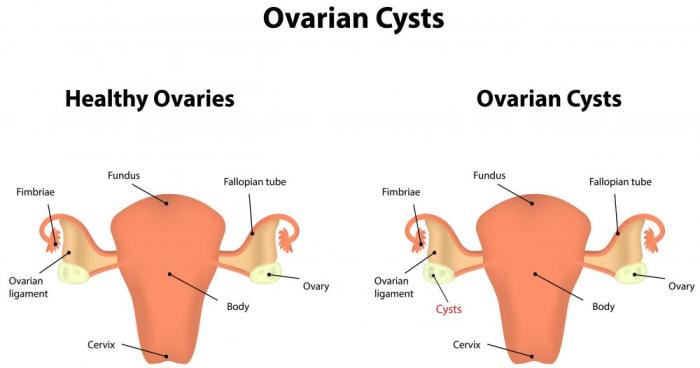 Ovarian cysts symptoms cyst know signs pain positivemed women should cause cancer ruptured before effects pelvic health painful pcos article