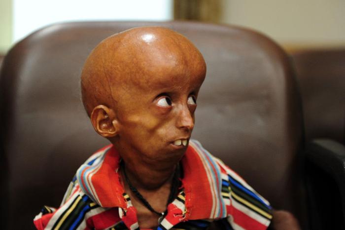 Apa itu Penyakit Progeria yang Bikin Pengidapnya Tua