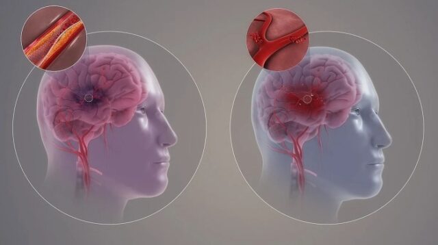 Golongan Darah Berisiko Terkena Stroke